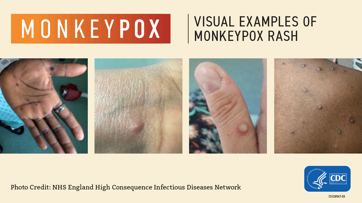 Mpox (Monkeypox): Signs, Symptoms, and Complications